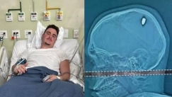 Φοιτητής στη Βραζιλία πάρταρε επί τέσσερις μέρες χωρίς να καταλάβει...ότι τον είχαν πυροβολήσει στο κεφάλι 